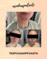 Saaren Taika Teepuusaippua, atooppiselle, kutisevalle ja akneiholle