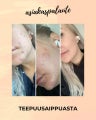 Saaren Taika Teepuusaippua, atooppiselle, kutisevalle ja akneiholle