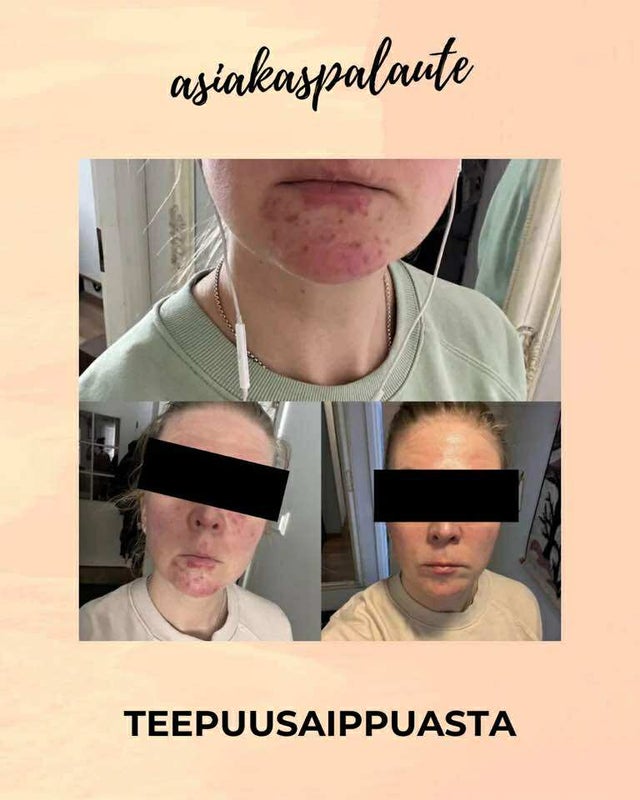 Saaren Taika Teepuusaippua, atooppiselle, kutisevalle ja akneiholle